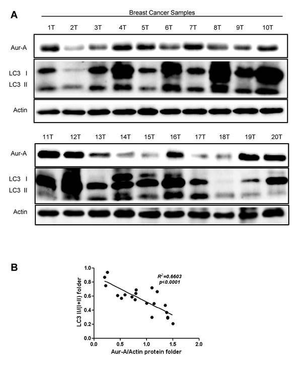 Aur-A expression was negatively correlated with autophagic level in breast cancer samples.