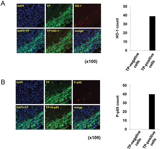 Localization of HO-1 and P-p65 in TP-positive gastric cancer tissue.