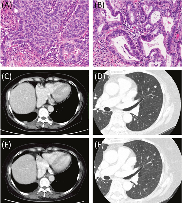 Histopathological findings and representative images of pre- and post-EGFR-TKI therapy.