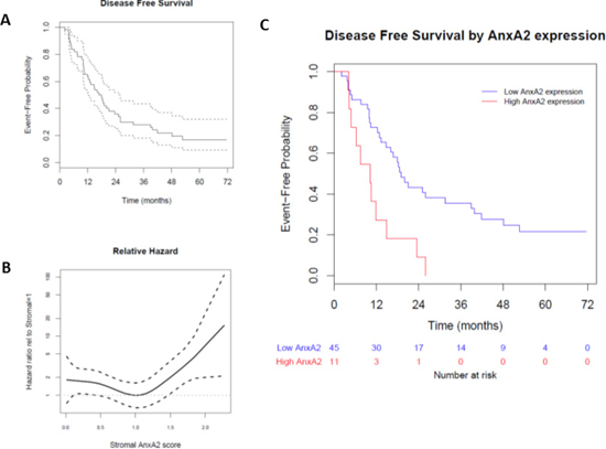 Effect of stromal AnxA2 score on disease-free survival in pancreatic cancer.