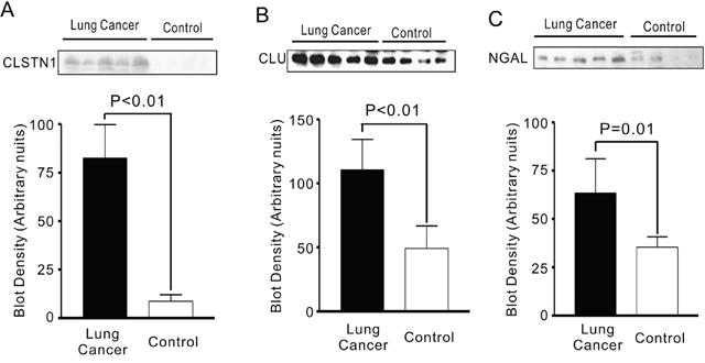 CLSTN1, CLU and NGAL expressions in serum from lung cancer patients and health controls.