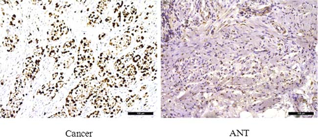 Immunohistochemical staining for Ki-67 in pairs of representative gastric cancer tissues with adjacent non-tumorous tissues (ANTs).