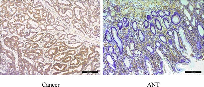 Immunohistochemical staining of SLC7A11 in pairs of representative gastric cancer tissues with adjacent non-tumorous tissues (ANT).
