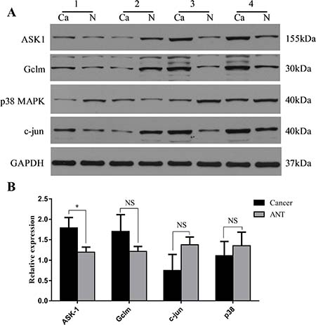 Expression changes of ASK1, Gclm, c-Jun and p38 were assessed in human SLC7A11-AS1low gastric cancer tissues.