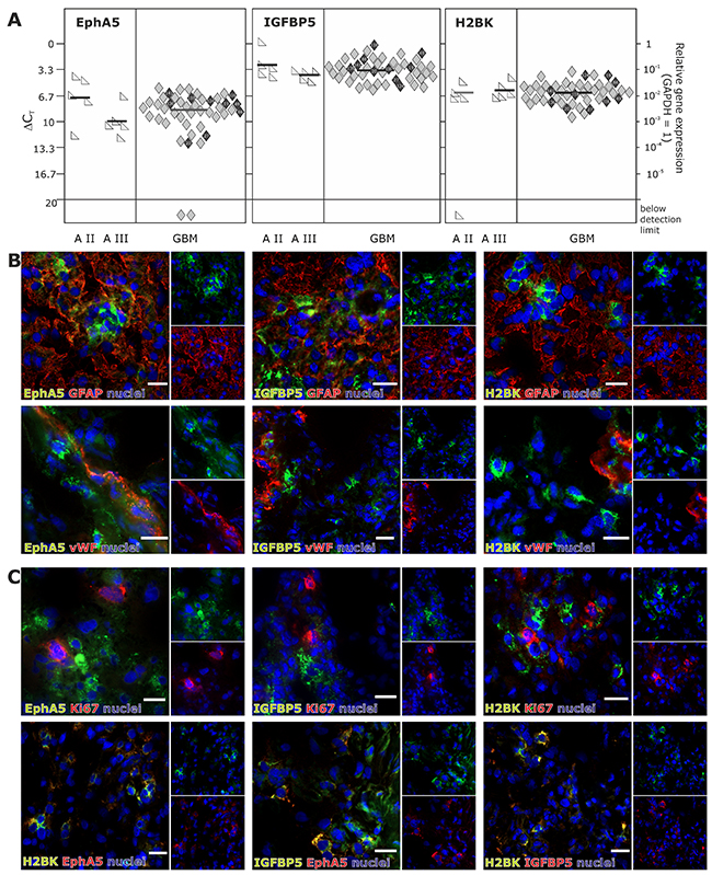 Expression of EphA5, IGFBP5 and H2BK in solid human glioblastoma (GBM) samples.