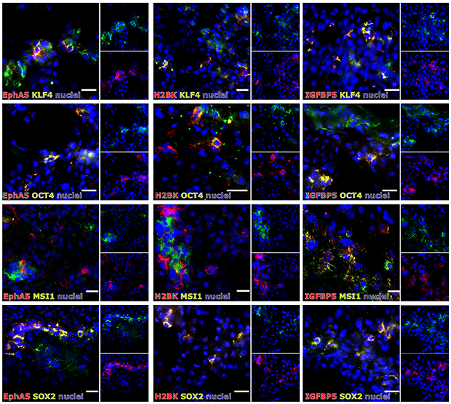 (Co)-Expression of EphA5, IGFBP5 and H2BK with the stem cell markers KLF4, OCT4, MSI1 or SOX2 in solid human GBM samples.