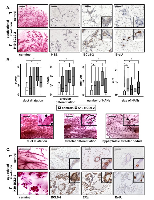 In vivo overexpression of BCL9-2 delays the postlactational and age-related involution and induces preneoplastic changes of the mammary gland in mice.