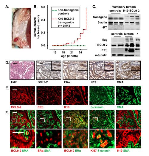 Aged BCL9-2 transgenic mice develop ER+ breast cancers.
