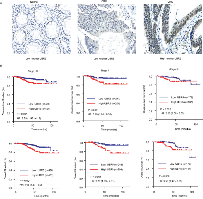 Association between nuclear UBR5 expression and patient survival in CRC.