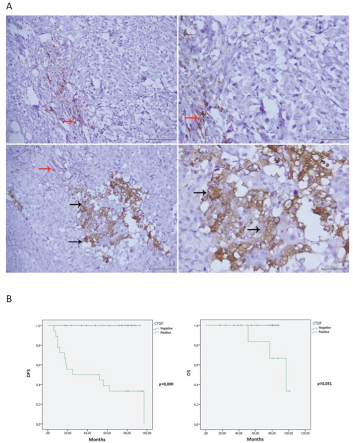 CTGF IHC staining in ER+ breast cancer tissues and Kaplan-Meier curves.