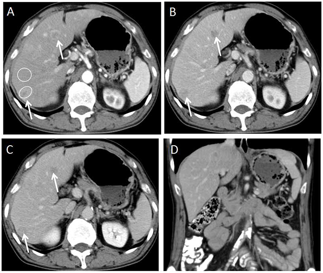 58-year-old male with G2 colon NET.