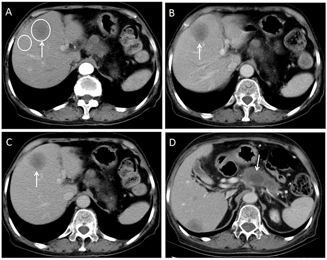 70-year-old woman with moderately-poorly differentiated pancreatic adenocarcinoma.