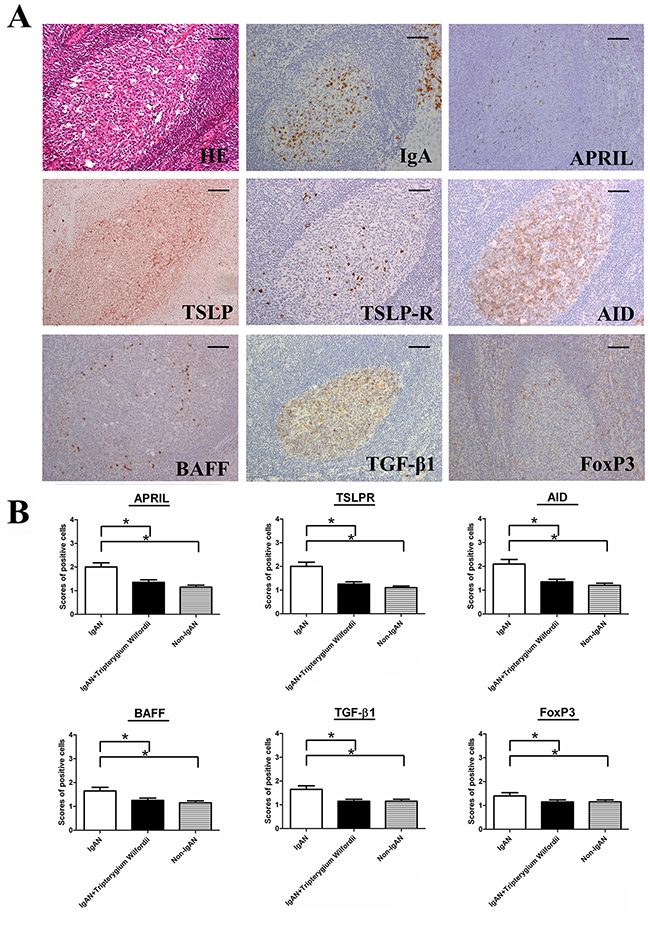 TSLP receptor (TSLPR), activation-induced cytidine deaminase (AID), transforming growth factor-&#x03B2;1 (TGF-&#x03B2;1), B cell-activating factor of the TNF family (BAFF) and a proliferation-inducing ligand (APRIL) were decreased in the tonsils of IgAN patients with Tripterygium Wilfordii treatment.