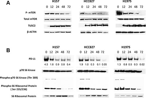 Transfection with TUSC2 reduces PD-L1 expression in non-small cell lung cancer.