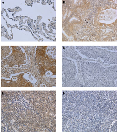 Immunohistochemical analysis of BAG3 expression in normal and neoplastic lung samples.