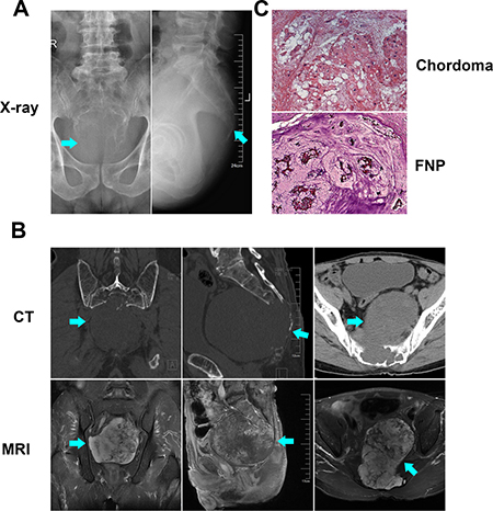 Radiological and pathological identification of chordoma.