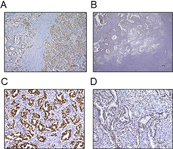 Immunohistochemical staining of FBXW7 in pancreatic cancer tissue.