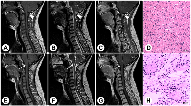 Radiological and histopathological profiles of a patient with concomitant rosette-forming glioneuronal tumor and schwannoma.