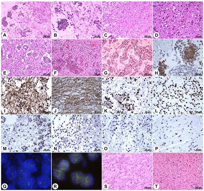 Histopathology and immunohistochemistry of rosette-forming glioneuronal tumors.