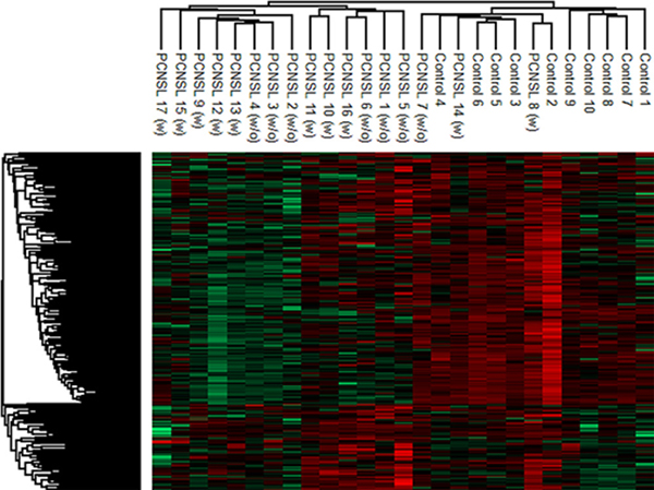 Hierarchical cluster analysis of the CSF proteome in PCNSL and control patients.