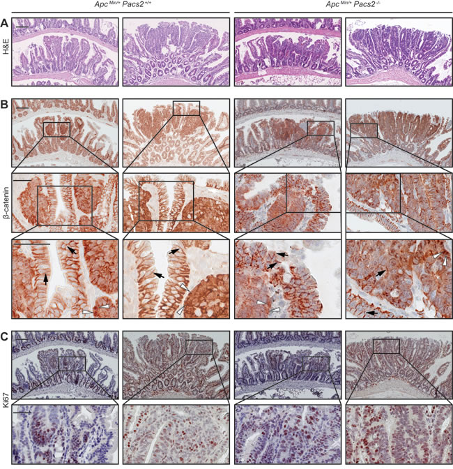 PACS-2 loss does not affect tumor morphology, &szlig;-catenin expression or cell proliferation in the