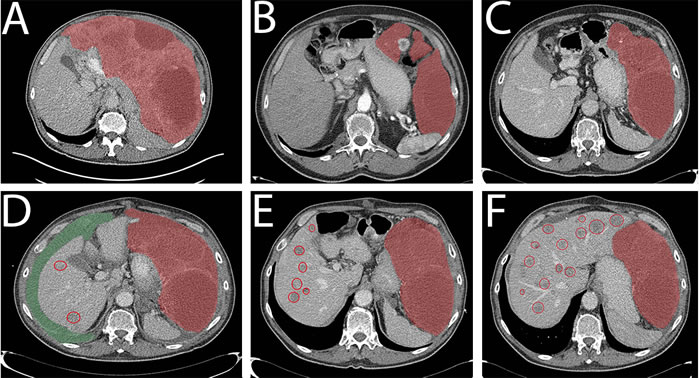 CT images of patient 1.