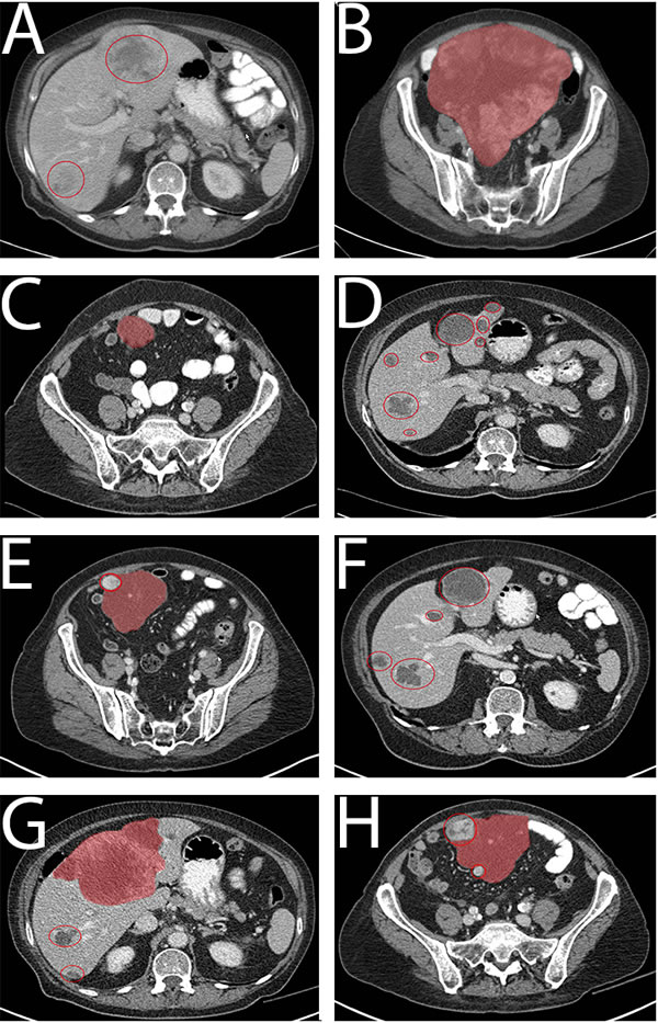 CT images of patient 2, left column images of pelvis, right column images of liver at the same time.