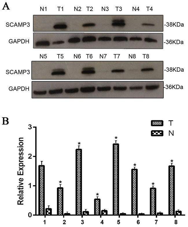The expression of SCAMP3 in HCC and adjacent normal tissues.
