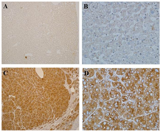 Immunohistochemical analysis of SCAMP3 expression in HCC and adjacent normal tissues.