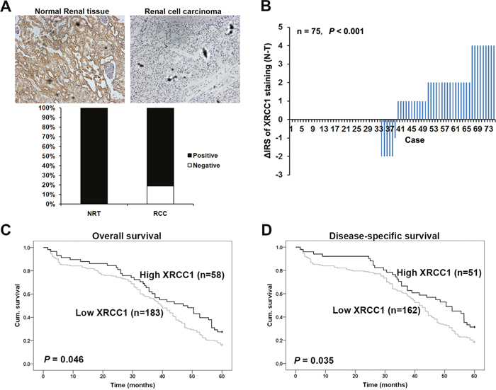 XRCC1 is decreased in ccRCC and associated with worse 5-year overall and disease-specific survival in ccRCC patients.