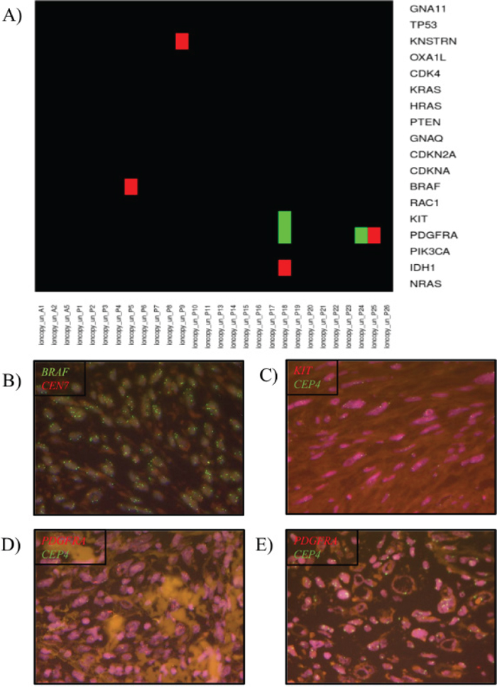 Copy number variation (CNV) in pleomorphic dermal sarcomas (PDS).