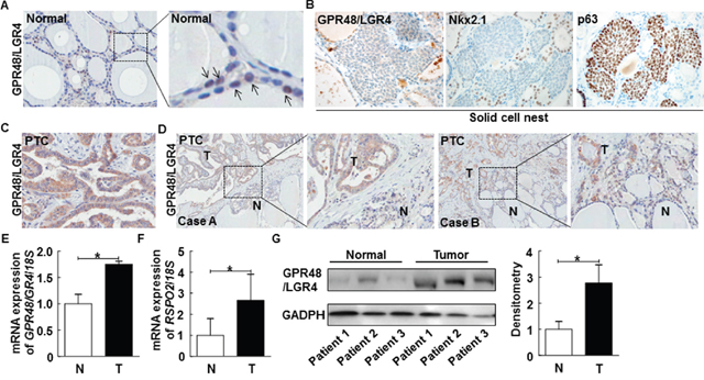 Representative expression of GPR48/LGR4 in human normal thyroid and thyroid carcinomas.