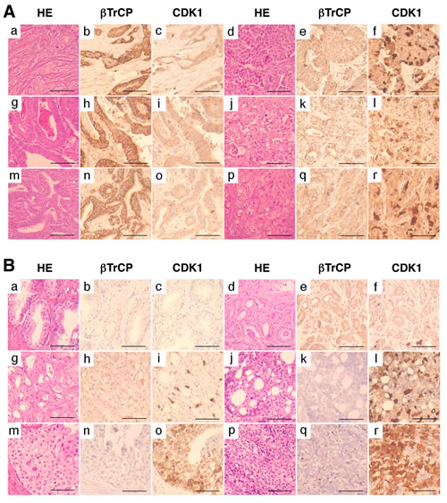 CDK1 accumulation in human tumors shows inverse correlation with &#x3b2;TrCP expression and is associated with tumor grade.