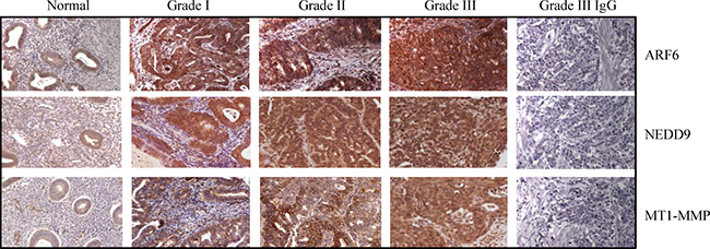 Expression of ARF6, NEDD9 and MT1-MMP is associated with endometrial tumor progression.