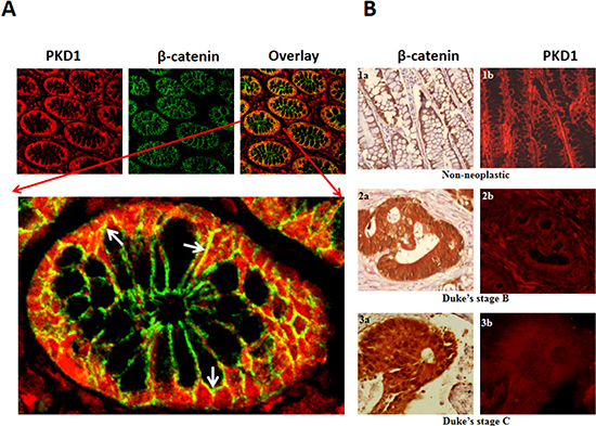 Figure 1. Expression of PKD1 is downregulated in colon cancer.