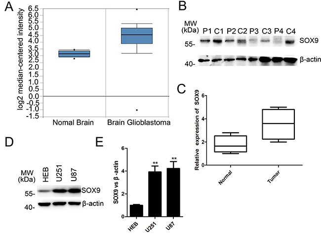 SOX9 was overexpressed both at the mRNA level and protein level in GBM.