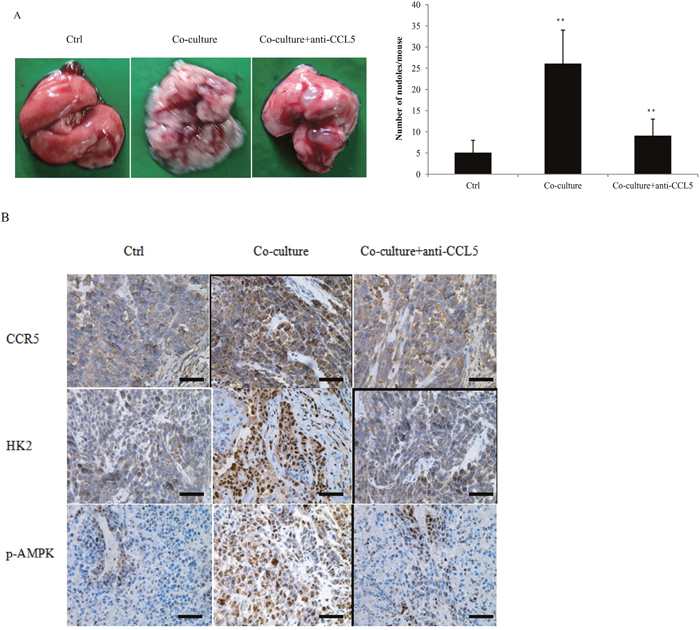 Macrophages promoted breast cancer metastasis through CCL5.