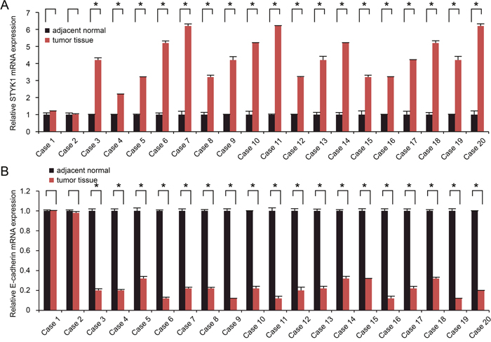 STYK1 and E-cadherin mRNA expression in pancreatic cancer tissues and paired adjacent normal tissues.