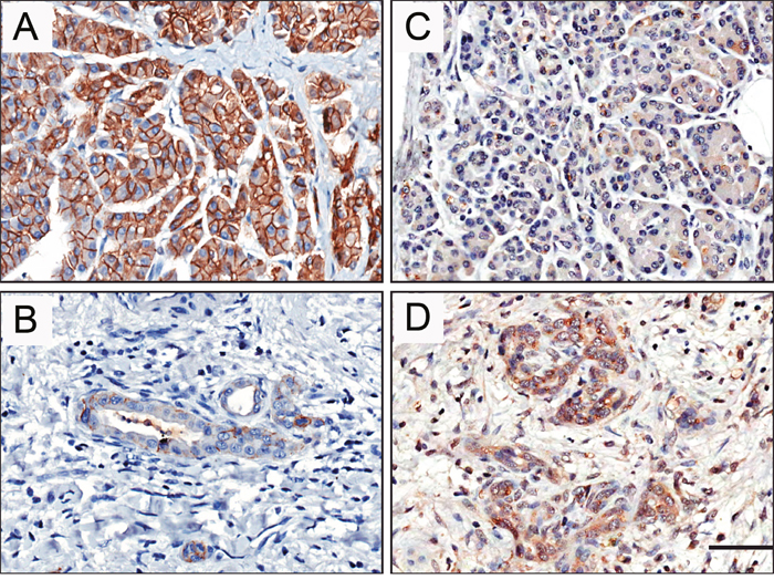 E-cadherin and STYK1 expression levels and localization in pancreatic cancer.