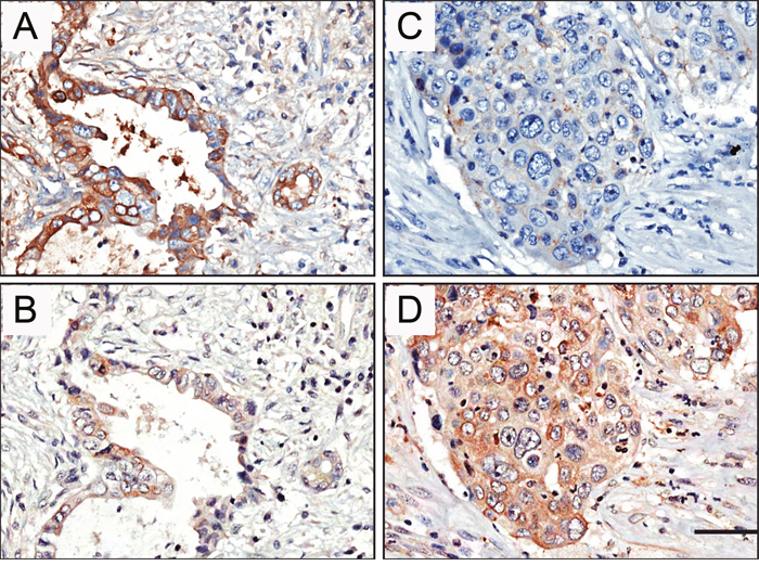 Representative pictures showed negative correlation of STYK1 and E-cadherin expression in pancreatic cancer tissue samples.