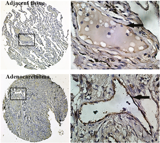 Immunohistochemistry for vWF using TMAs of human lung adenocarcinoma tissues and adjacent normal lung tissues.