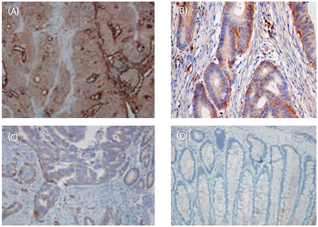 Figure 2:Immunohistochemical map of IL-35 in colon cancer tissues and adjacent tissues (SP, &#x00D7;200).