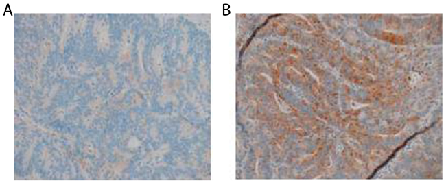 Immunohistochemistry of &#x03B2;-catenin in colon cancer tissues of patients with or without metastasis (SP, &#x00D7;200).