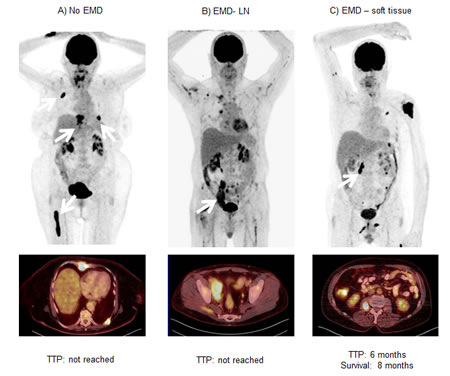 Negative prognostic value of extramedullary soft tissue lesions.