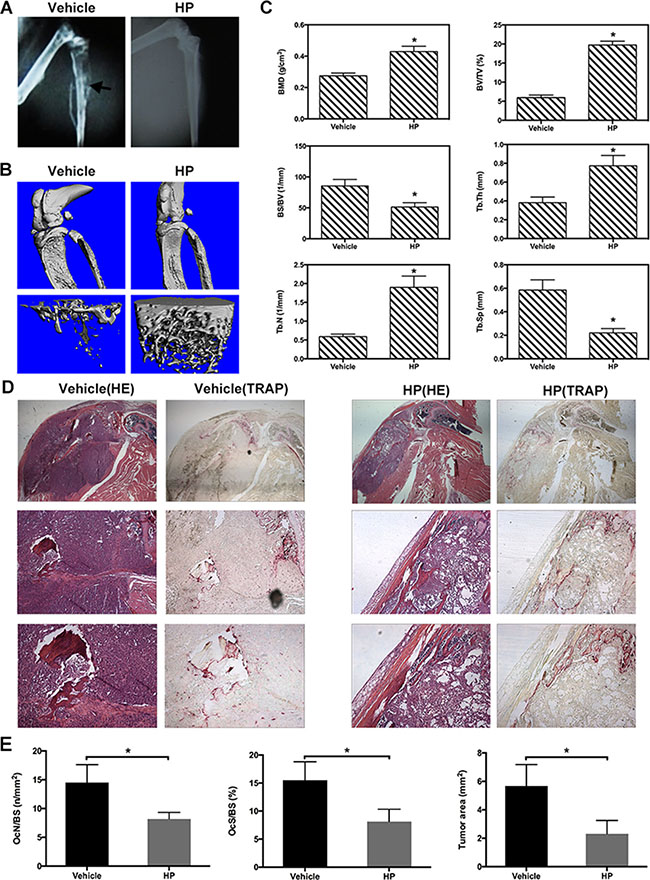 Hypericin reduces osteolysis and preserves trabecular/cancellous bone in human MDA-MB-231 breast cancer-bearing mice.