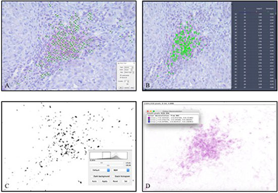 Manual counting and software-assisted counting methods shown representatively in one hot spot of infiltrating CD3+ T-lymphocytes in hepatocellular carcinoma.