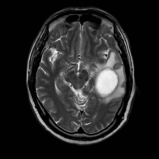 In September 2016, MR scan showed brain occupancy.