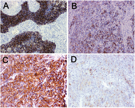 Immunohistochemical staining for LKB1 and MMP-2 in human melanoma tissue.