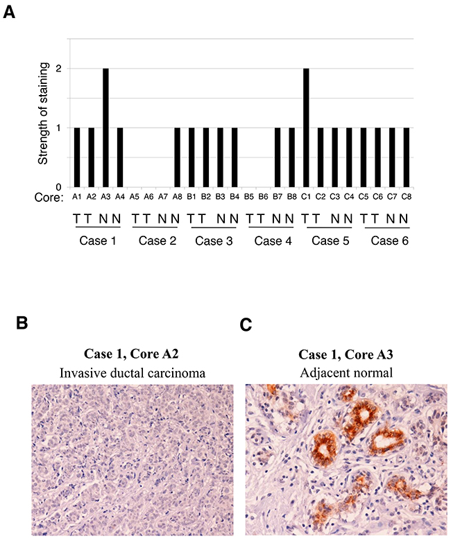 FRK expression in breast cancer tissues.