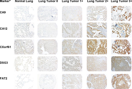 Representative images of IHC stained patient lung tumor and normal lung tissue specimens from the tissue microarray (TMA) for half of the selected markers.
